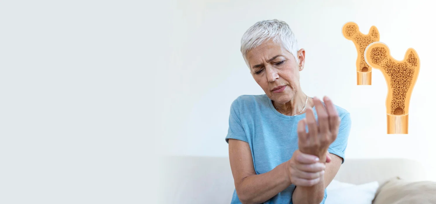 Csontritkulás: ne várjuk meg a súlyos szövődményeket